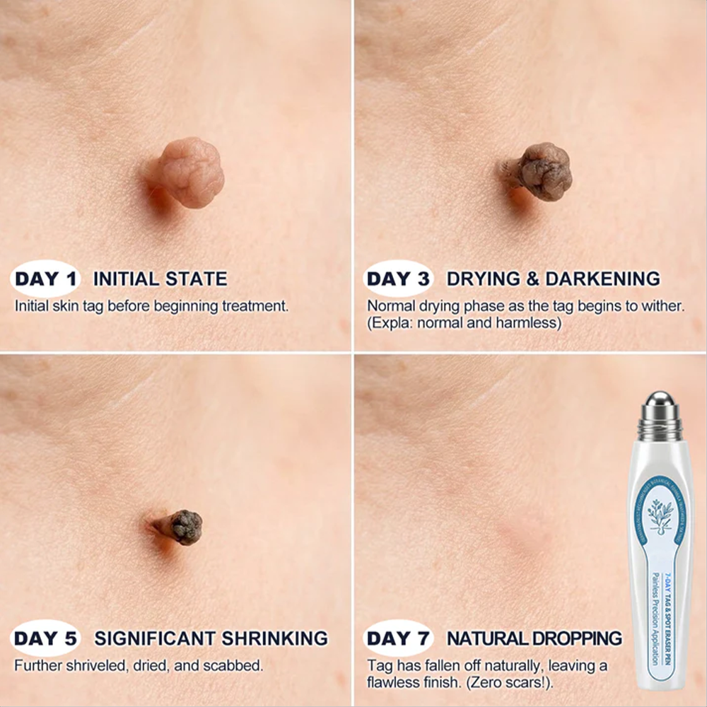 𝟕-𝐃𝒂𝘆 𝐒𝗸𝐢𝐧 𝐓𝒂𝗴 & 𝐒𝐩𝙤𝐭 𝐄𝐫𝒂𝐬𝙚𝐫,Painless & Scar-Free  Advanced Imperfection Removal Rollerball Pen