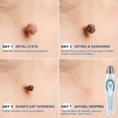 𝟕-𝐃𝒂𝘆 𝐒𝗸𝐢𝐧 𝐓𝒂𝗴 & 𝐒𝐩𝙤𝐭 𝐄𝐫𝒂𝐬𝙚𝐫,Painless & Scar-Free  Advanced Imperfection Removal Rollerball Pen