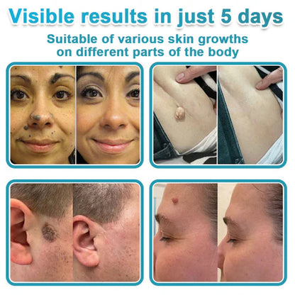 🌿2-in-1 Microneedle & Hydrocolloid Patch & Invisible Face & Body Patches for Raised Moles, Acne, Flat Warts & Skin Tags - Helps Improve the Appearance of Wrinkles, Scars & Blemishes