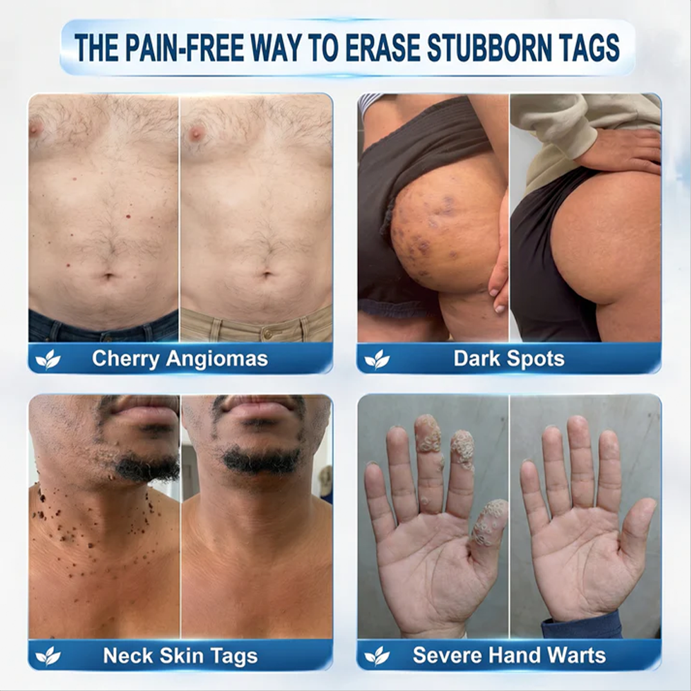 𝟕-𝐃𝒂𝘆 𝐒𝗸𝐢𝐧 𝐓𝒂𝗴 & 𝐒𝐩𝙤𝐭 𝐄𝐫𝒂𝐬𝙚𝐫,Painless & Scar-Free  Advanced Imperfection Removal Rollerball Pen