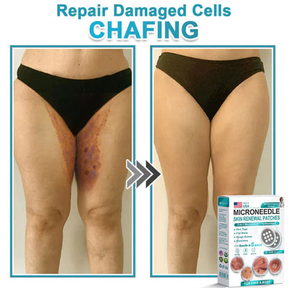 2-in-1 Microneedle & Hydrocolloid Patch 🌿 Invisible Face & Body Patches for Raised Moles, Acne, Flat Warts & Skin Tags - Helps Improve the Appearance of Wrinkles, Scars & Blemishes