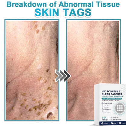 🌿2-in-1 Microneedle & Hydrocolloid Patch & Invisible Face & Body Patches for Raised Moles, Acne, Flat Warts & Skin Tags - Helps Improve the Appearance of Wrinkles, Scars & Blemishes