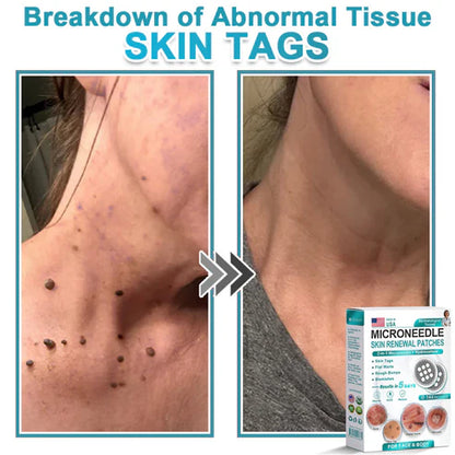2-in-1 Microneedle & Hydrocolloid Patch 🌿 Invisible Face & Body Patches for Raised Moles, Acne, Flat Warts & Skin Tags - Helps Improve the Appearance of Wrinkles, Scars & Blemishes