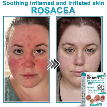 2-in-1 Microneedle & Hydrocolloid Patch 🌿 Invisible Face & Body Patches for Raised Moles, Acne, Flat Warts & Skin Tags - Helps Improve the Appearance of Wrinkles, Scars & Blemishes