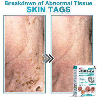 2-in-1 Microneedle & Hydrocolloid Patch 🌿 Invisible Face & Body Patches for Raised Moles, Acne, Flat Warts & Skin Tags - Helps Improve the Appearance of Wrinkles, Scars & Blemishes